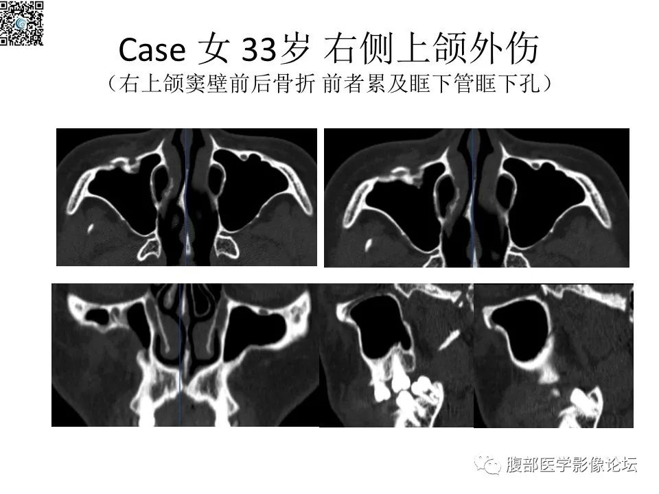 影像PPT - 【PPT】颅骨颅底系列之八面灵通翼腭窝-52