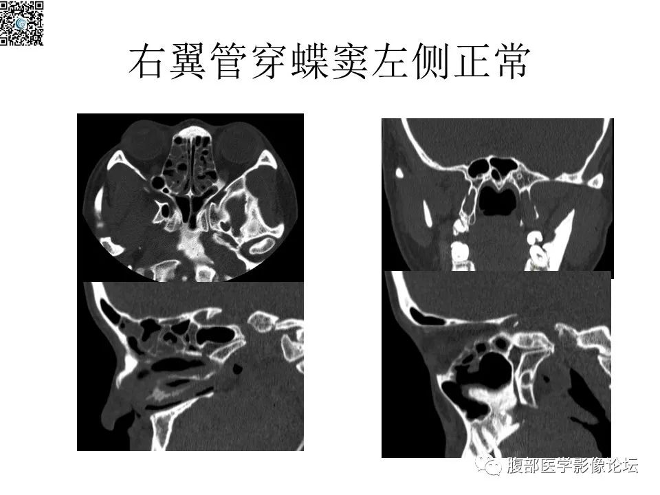 影像PPT - 【PPT】颅骨颅底系列之八面灵通翼腭窝-53
