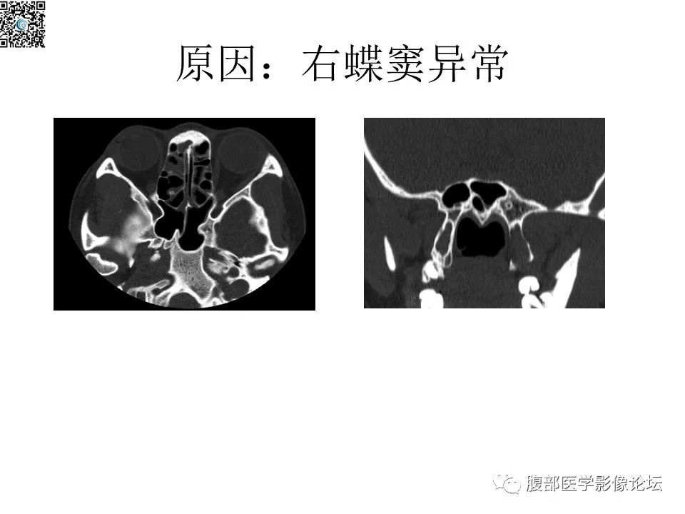 影像PPT - 【PPT】颅骨颅底系列之八面灵通翼腭窝-54