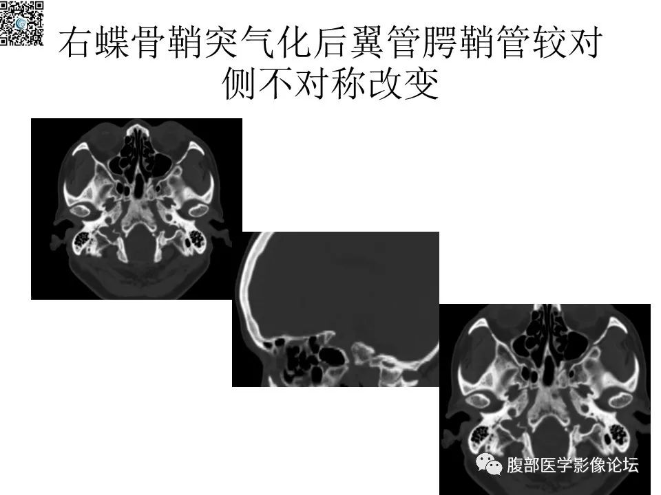 影像PPT - 【PPT】颅骨颅底系列之八面灵通翼腭窝-55