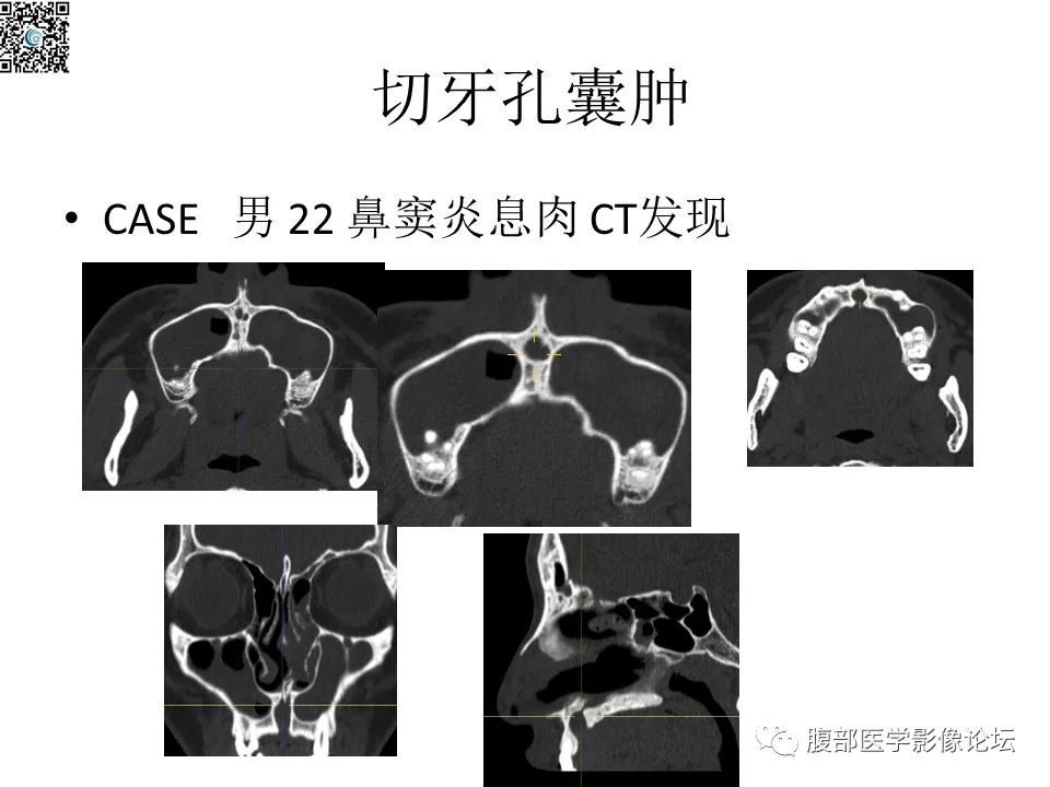影像PPT - 【PPT】颅骨颅底系列之八面灵通翼腭窝-57