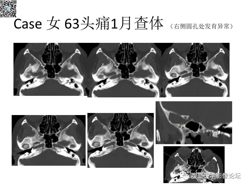 影像PPT - 【PPT】颅骨颅底系列之八面灵通翼腭窝-56
