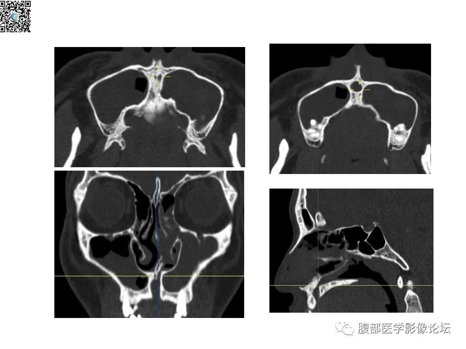 影像PPT - 【PPT】颅骨颅底系列之八面灵通翼腭窝-58