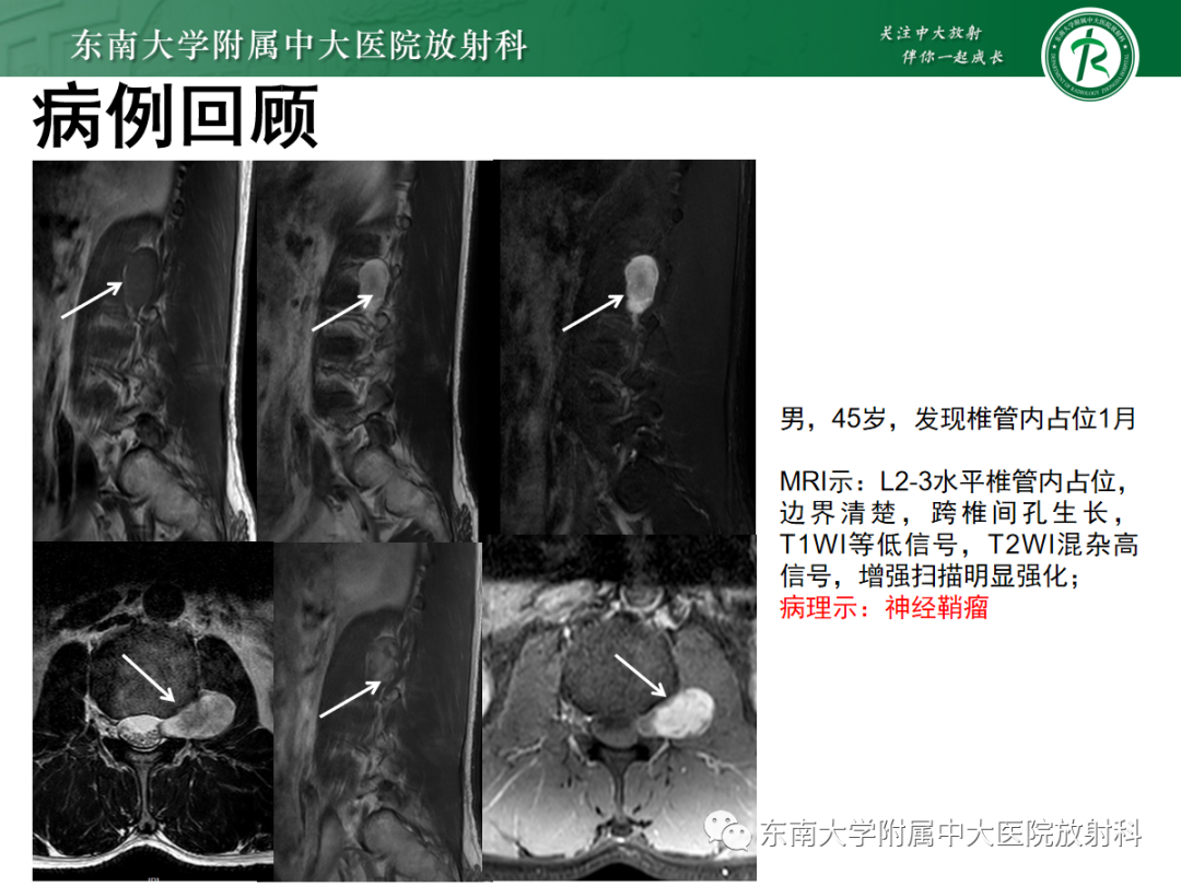 影像PPT - 【PPT】椎管内神经鞘瘤的影像-2