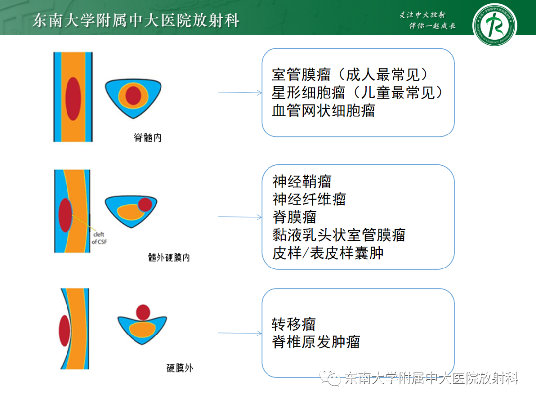 影像PPT - 【PPT】椎管内神经鞘瘤的影像-5