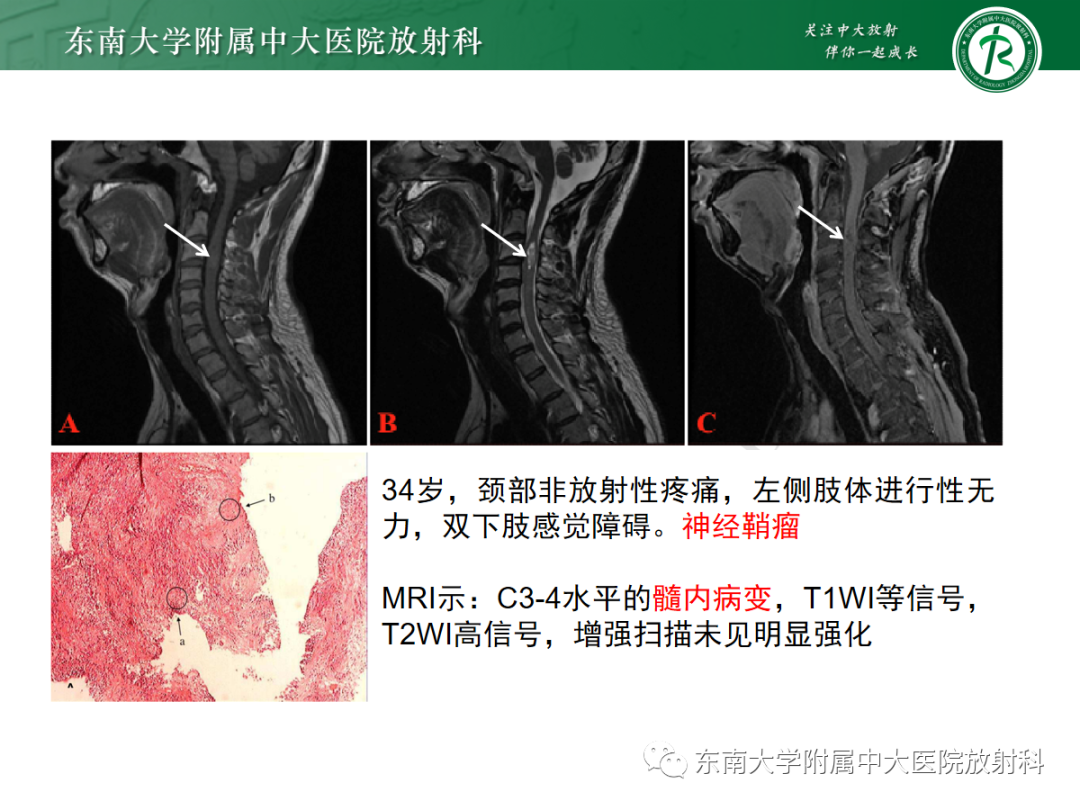 影像PPT - 【PPT】椎管内神经鞘瘤的影像-11