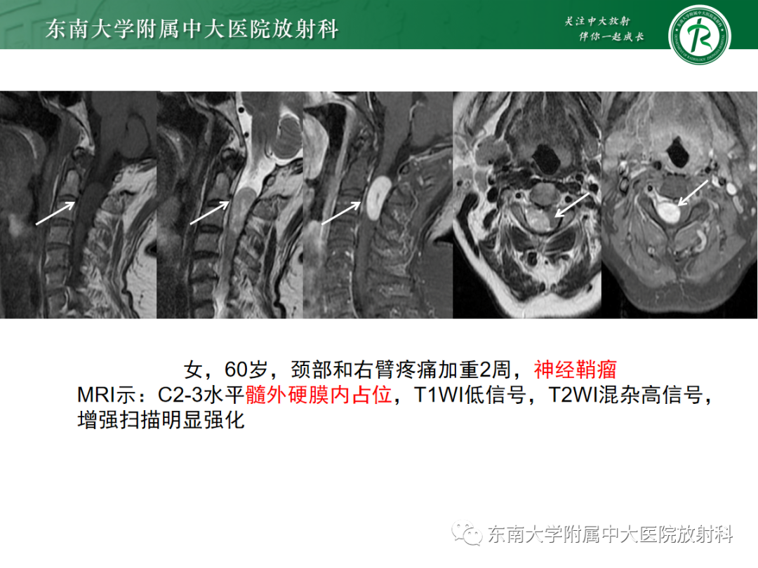 影像PPT - 【PPT】椎管内神经鞘瘤的影像-9