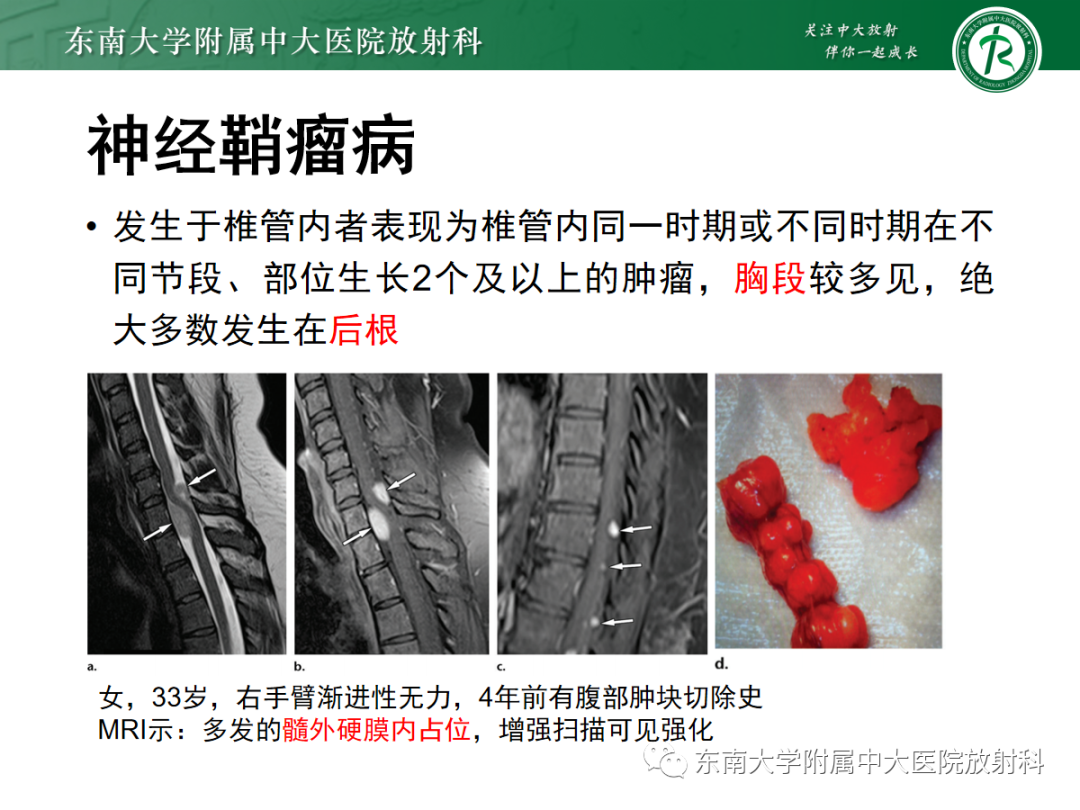 影像PPT - 【PPT】椎管内神经鞘瘤的影像-13
