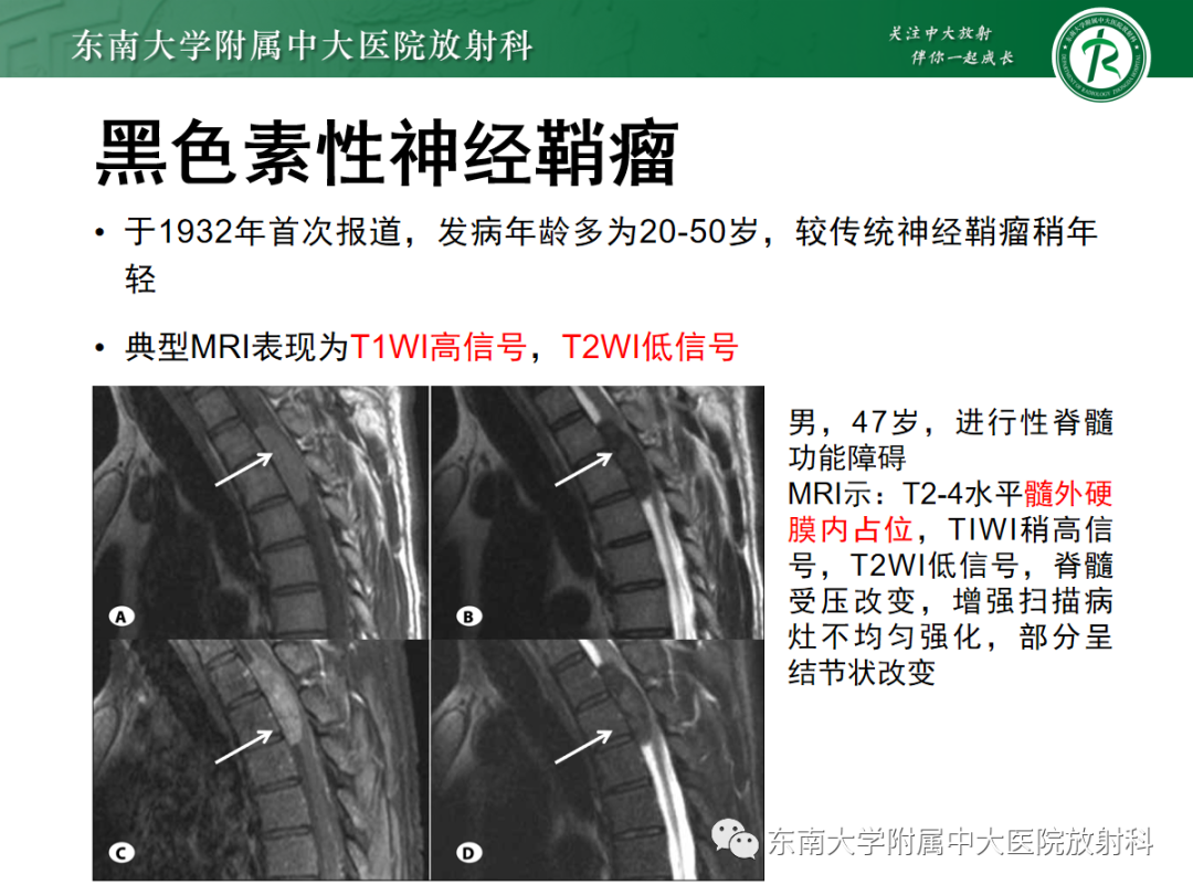 影像PPT - 【PPT】椎管内神经鞘瘤的影像-12