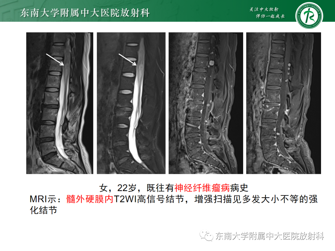 影像PPT - 【PPT】椎管内神经鞘瘤的影像-17