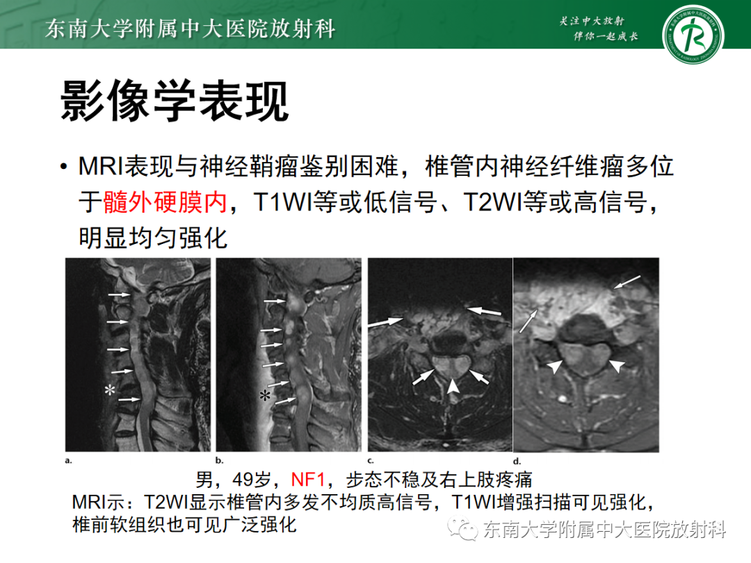 影像PPT - 【PPT】椎管内神经鞘瘤的影像-16