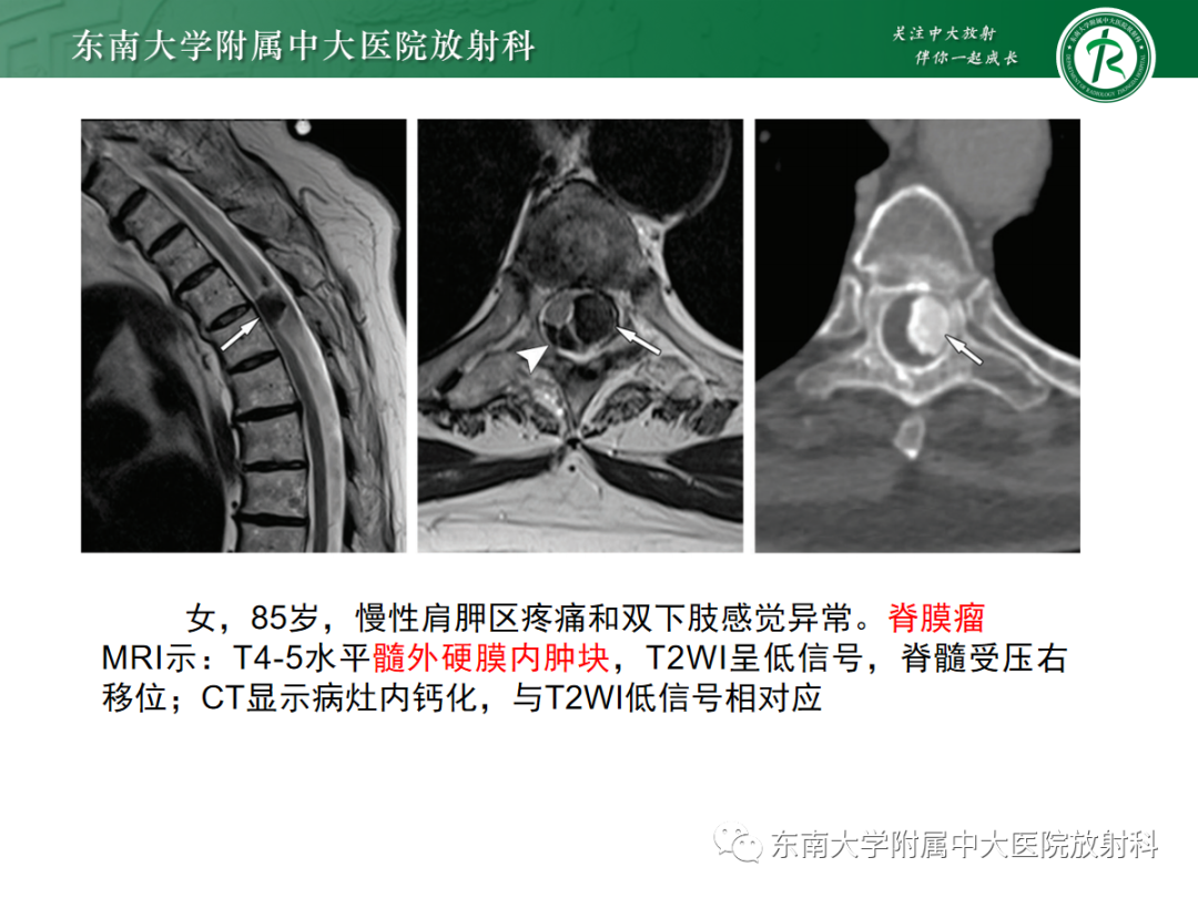 影像PPT - 【PPT】椎管内神经鞘瘤的影像-20