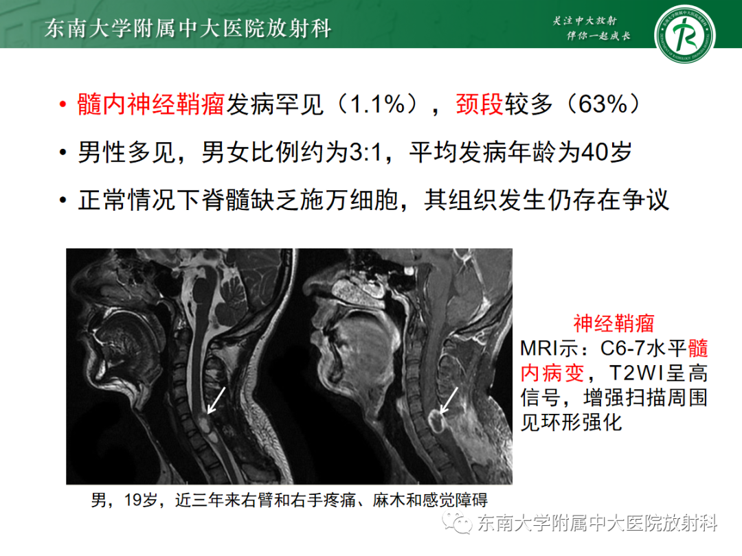 影像PPT - 【PPT】椎管内神经鞘瘤的影像-10