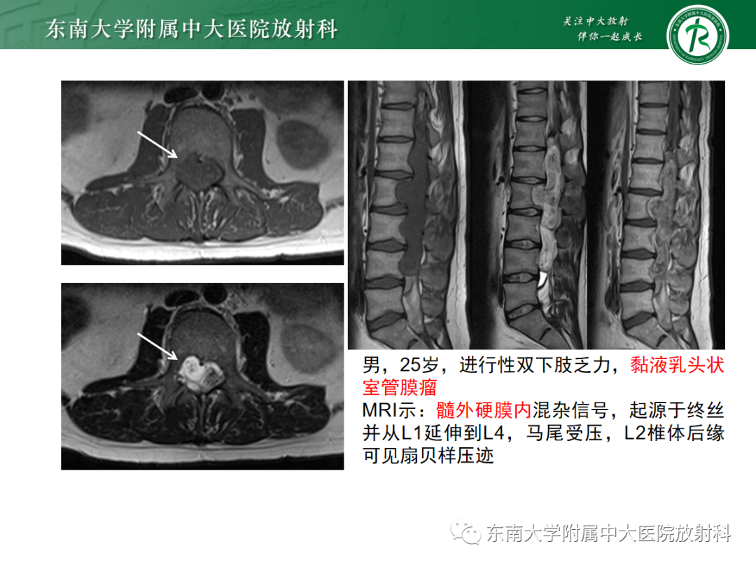 影像PPT - 【PPT】椎管内神经鞘瘤的影像-24