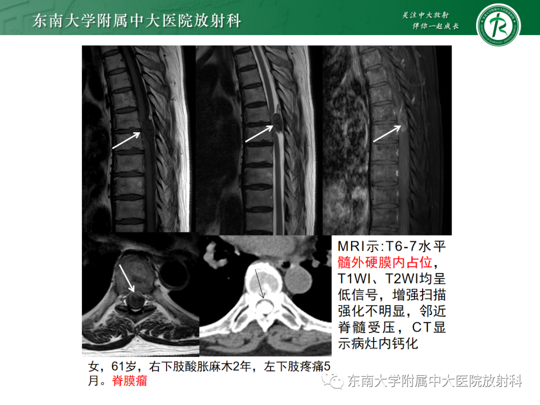 影像PPT - 【PPT】椎管内神经鞘瘤的影像-21