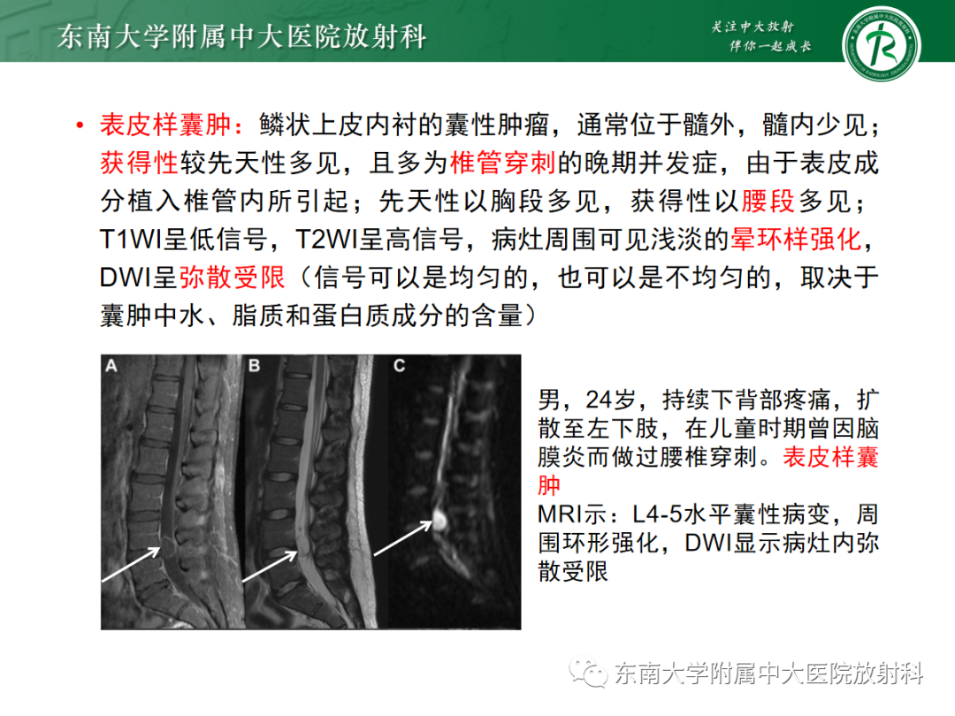 影像PPT - 【PPT】椎管内神经鞘瘤的影像-26