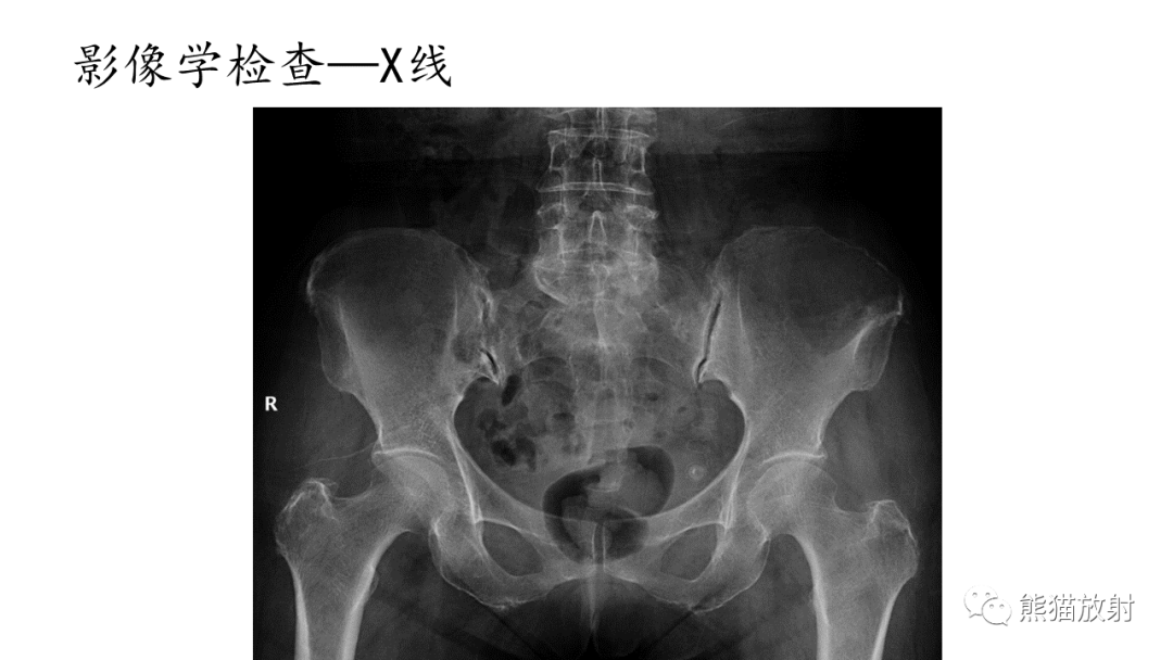 影像PPT - 【病例】髂骨孤立性浆细胞瘤VS骨巨细胞瘤-4