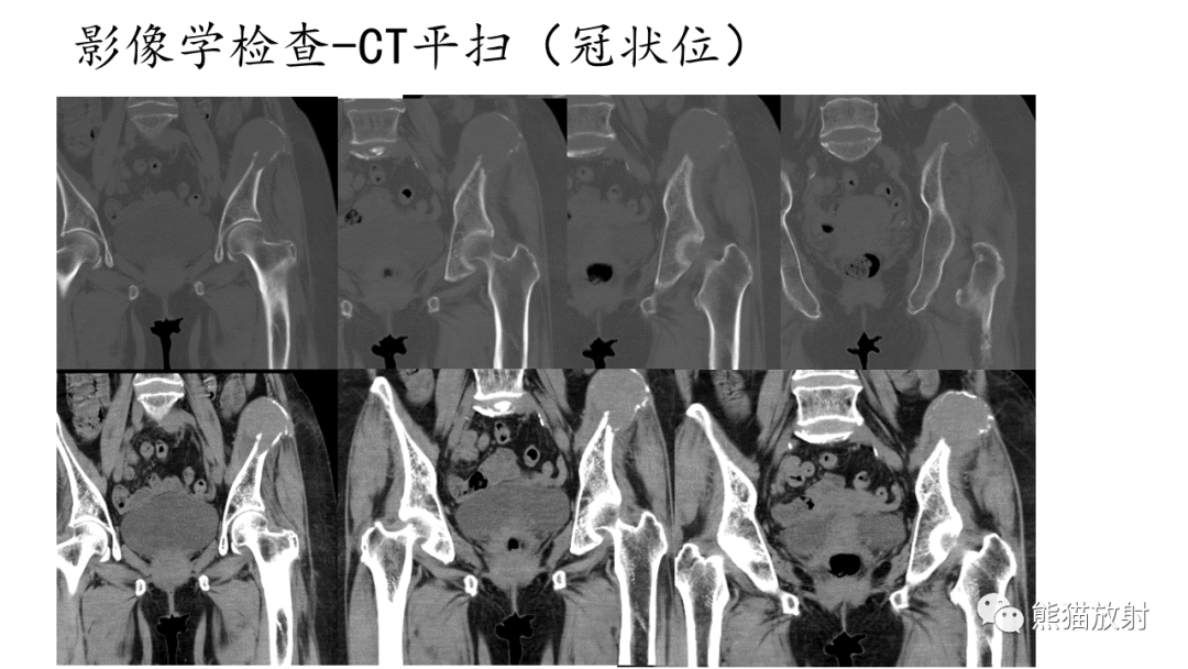 影像PPT - 【病例】髂骨孤立性浆细胞瘤VS骨巨细胞瘤-6