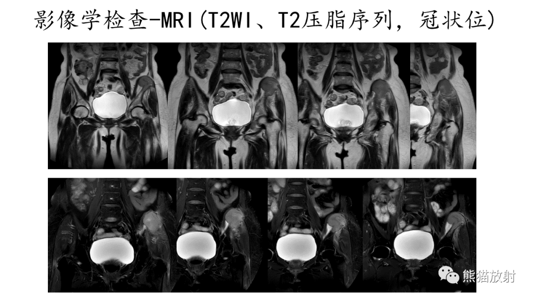 影像PPT - 【病例】髂骨孤立性浆细胞瘤VS骨巨细胞瘤-8