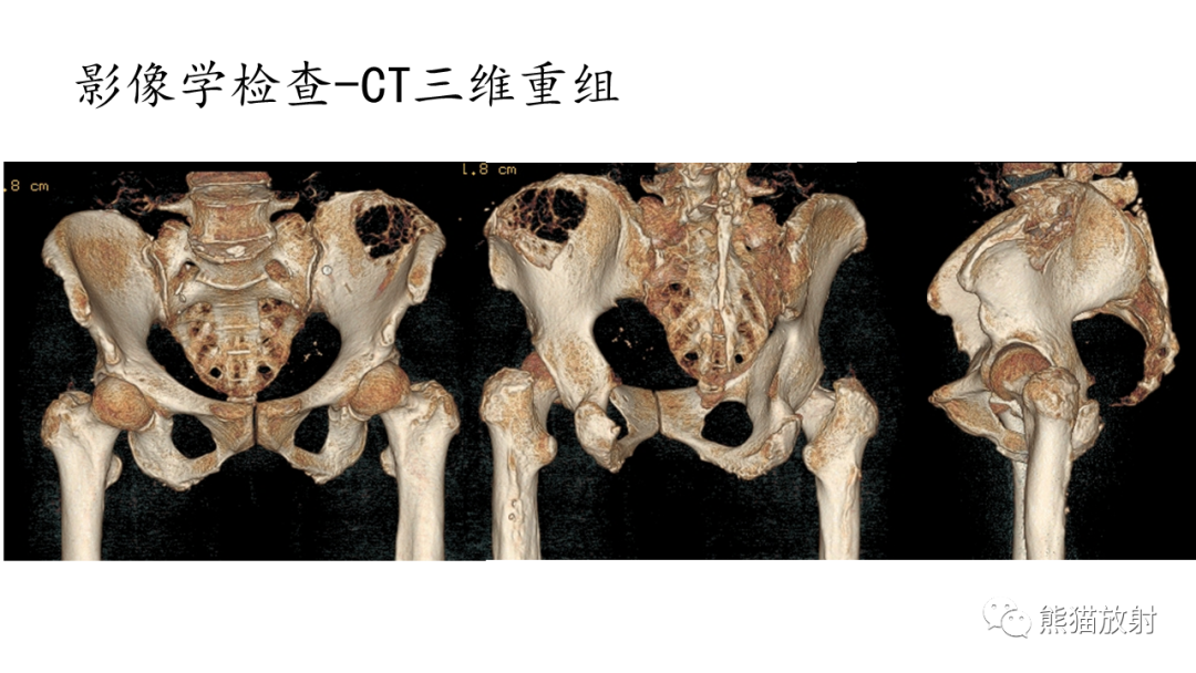影像PPT - 【病例】髂骨孤立性浆细胞瘤VS骨巨细胞瘤-7