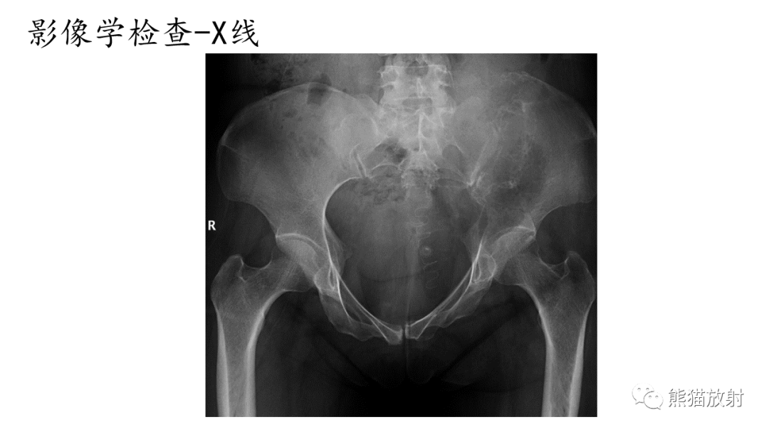 影像PPT - 【病例】髂骨孤立性浆细胞瘤VS骨巨细胞瘤-14
