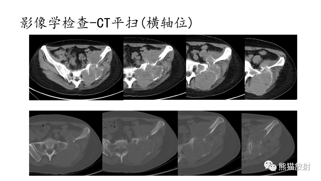 影像PPT - 【病例】髂骨孤立性浆细胞瘤VS骨巨细胞瘤-15