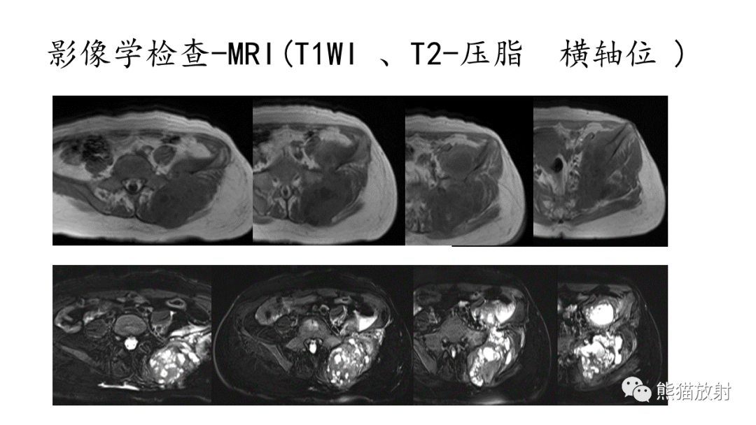 影像PPT - 【病例】髂骨孤立性浆细胞瘤VS骨巨细胞瘤-17