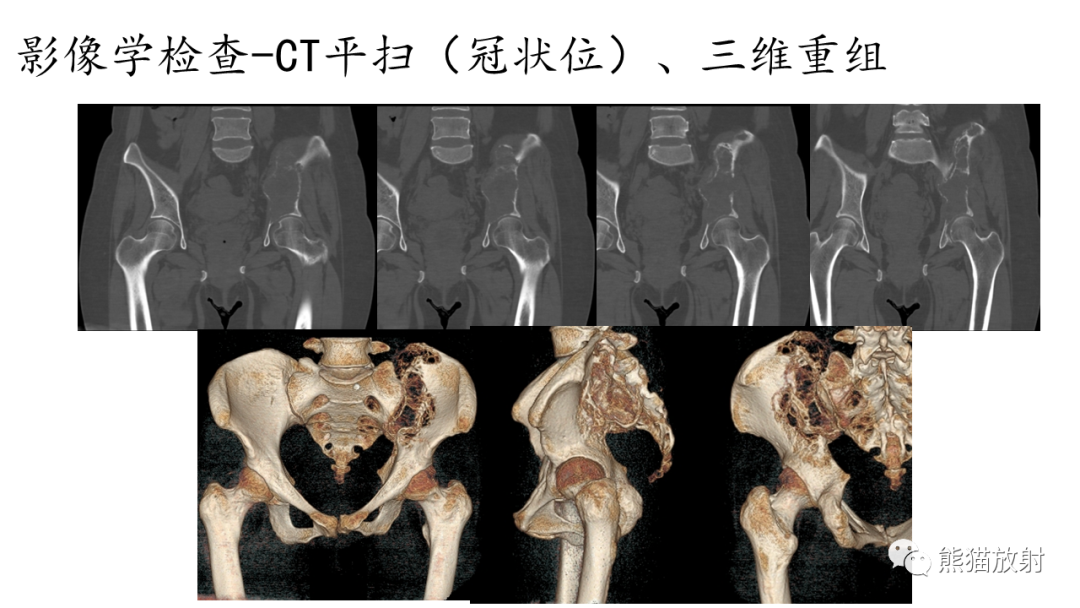 影像PPT - 【病例】髂骨孤立性浆细胞瘤VS骨巨细胞瘤-16