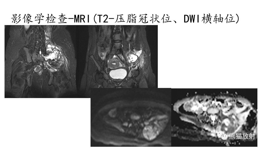 影像PPT - 【病例】髂骨孤立性浆细胞瘤VS骨巨细胞瘤-18