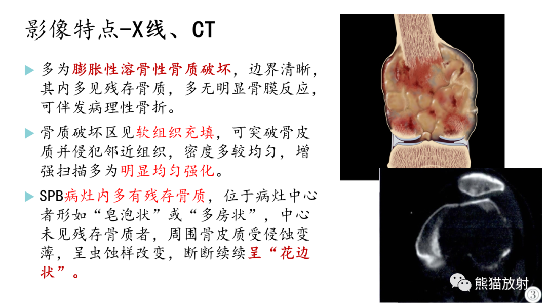 影像PPT - 【病例】髂骨孤立性浆细胞瘤VS骨巨细胞瘤-26