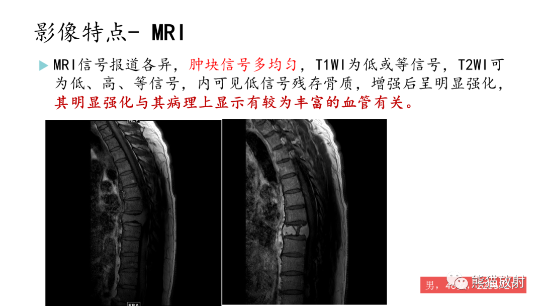 影像PPT - 【病例】髂骨孤立性浆细胞瘤VS骨巨细胞瘤-27