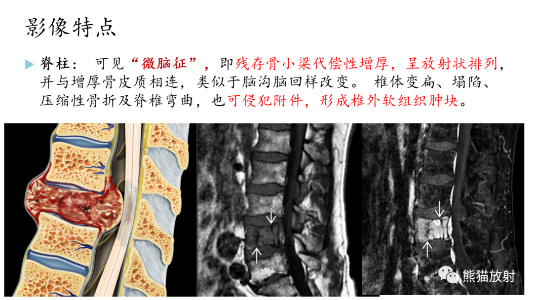 影像PPT - 【病例】髂骨孤立性浆细胞瘤VS骨巨细胞瘤-28