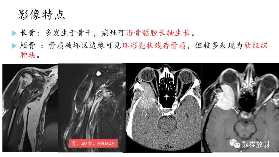 影像PPT - 【病例】髂骨孤立性浆细胞瘤VS骨巨细胞瘤-29