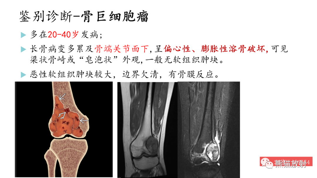 影像PPT - 【病例】髂骨孤立性浆细胞瘤VS骨巨细胞瘤-31