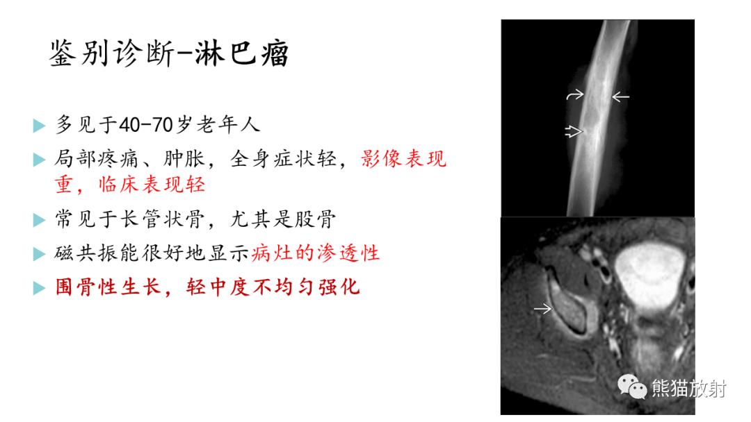 影像PPT - 【病例】髂骨孤立性浆细胞瘤VS骨巨细胞瘤-33
