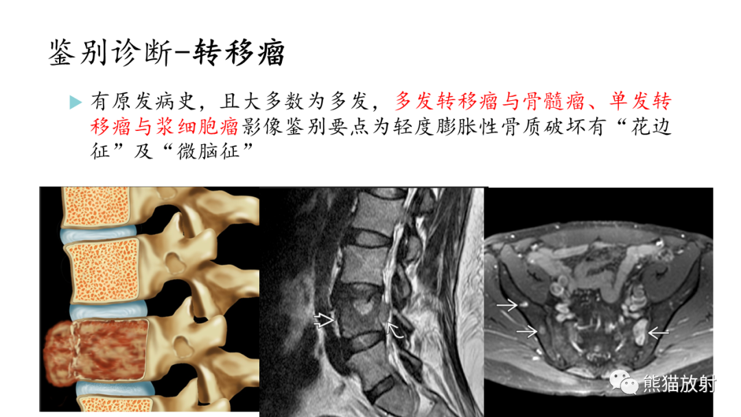影像PPT - 【病例】髂骨孤立性浆细胞瘤VS骨巨细胞瘤-32
