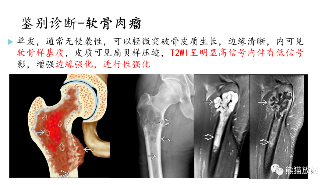 影像PPT - 【病例】髂骨孤立性浆细胞瘤VS骨巨细胞瘤-34