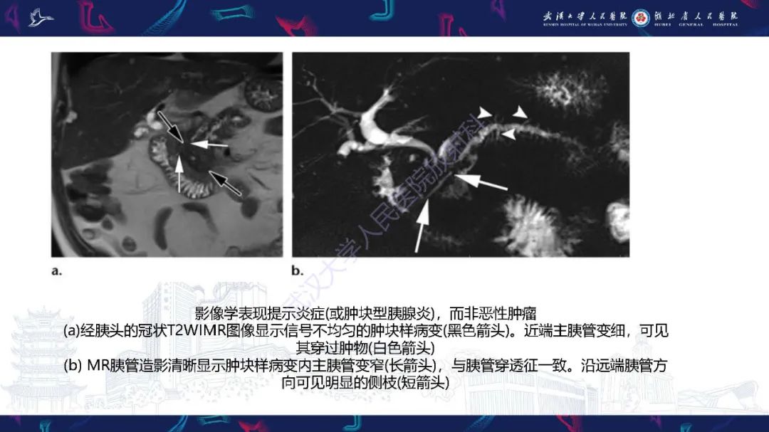 影像PPT - 【PPT】慢性胰腺炎与胰腺肿瘤影像鉴别诊断-14
