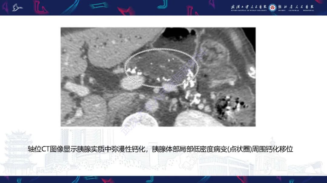 影像PPT - 【PPT】慢性胰腺炎与胰腺肿瘤影像鉴别诊断-18