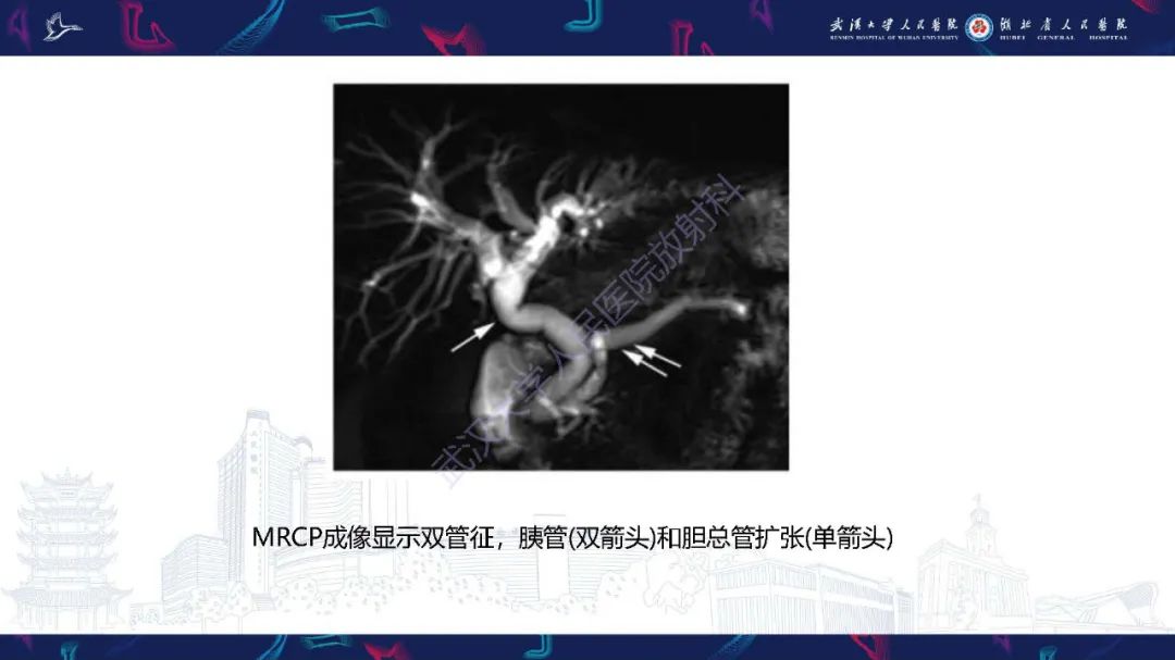 影像PPT - 【PPT】慢性胰腺炎与胰腺肿瘤影像鉴别诊断-20