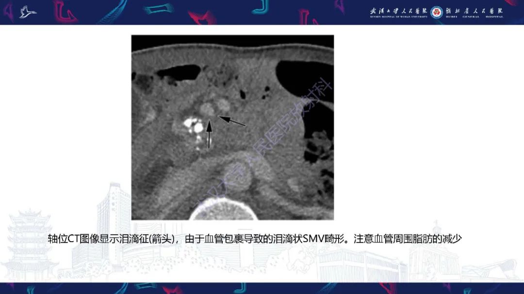 影像PPT - 【PPT】慢性胰腺炎与胰腺肿瘤影像鉴别诊断-22