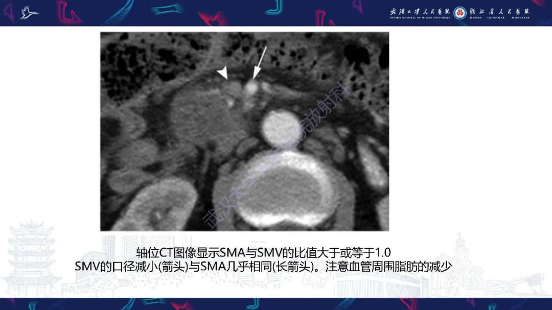 影像PPT - 【PPT】慢性胰腺炎与胰腺肿瘤影像鉴别诊断-24