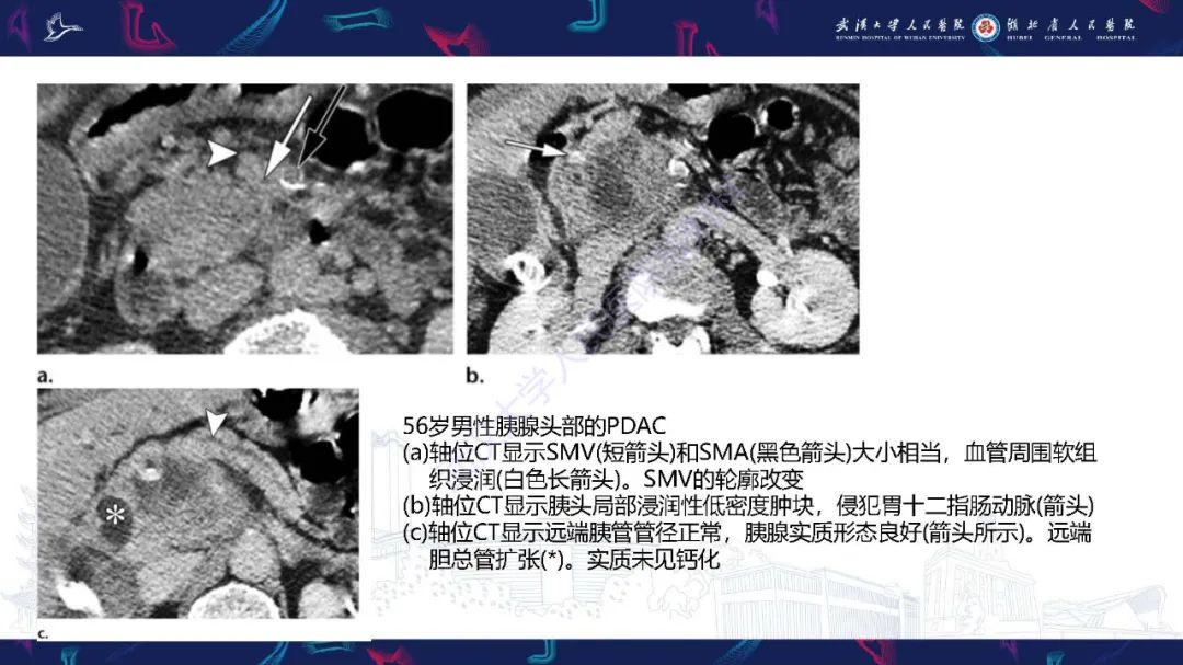 影像PPT - 【PPT】慢性胰腺炎与胰腺肿瘤影像鉴别诊断-26