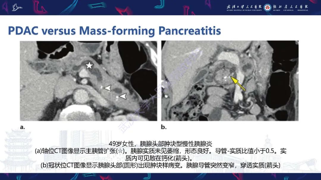 影像PPT - 【PPT】慢性胰腺炎与胰腺肿瘤影像鉴别诊断-25
