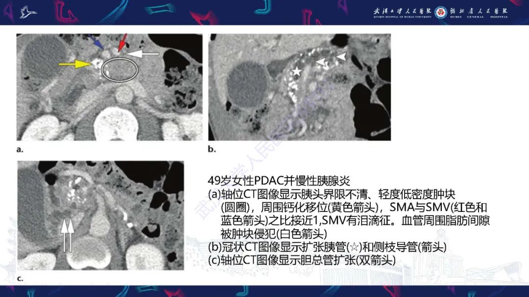 影像PPT - 【PPT】慢性胰腺炎与胰腺肿瘤影像鉴别诊断-28