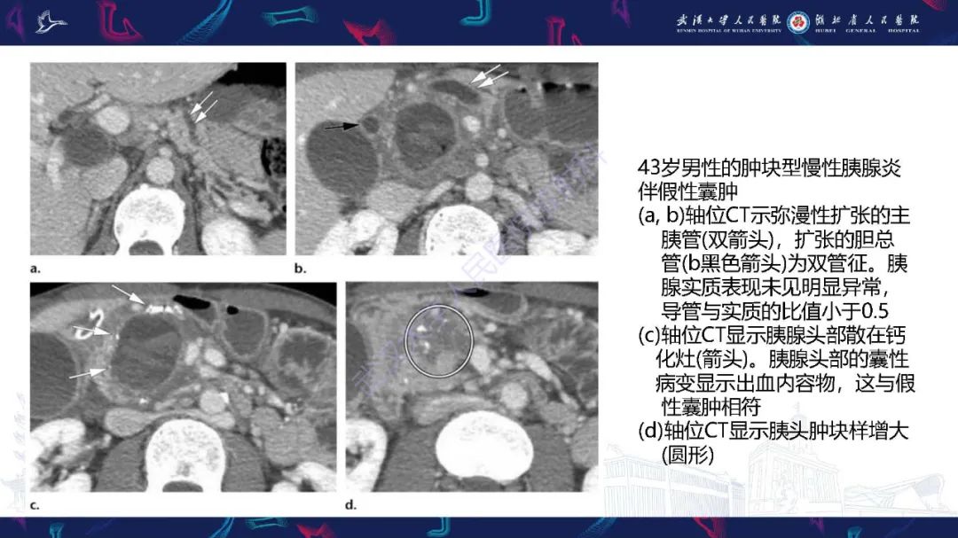 影像PPT - 【PPT】慢性胰腺炎与胰腺肿瘤影像鉴别诊断-27