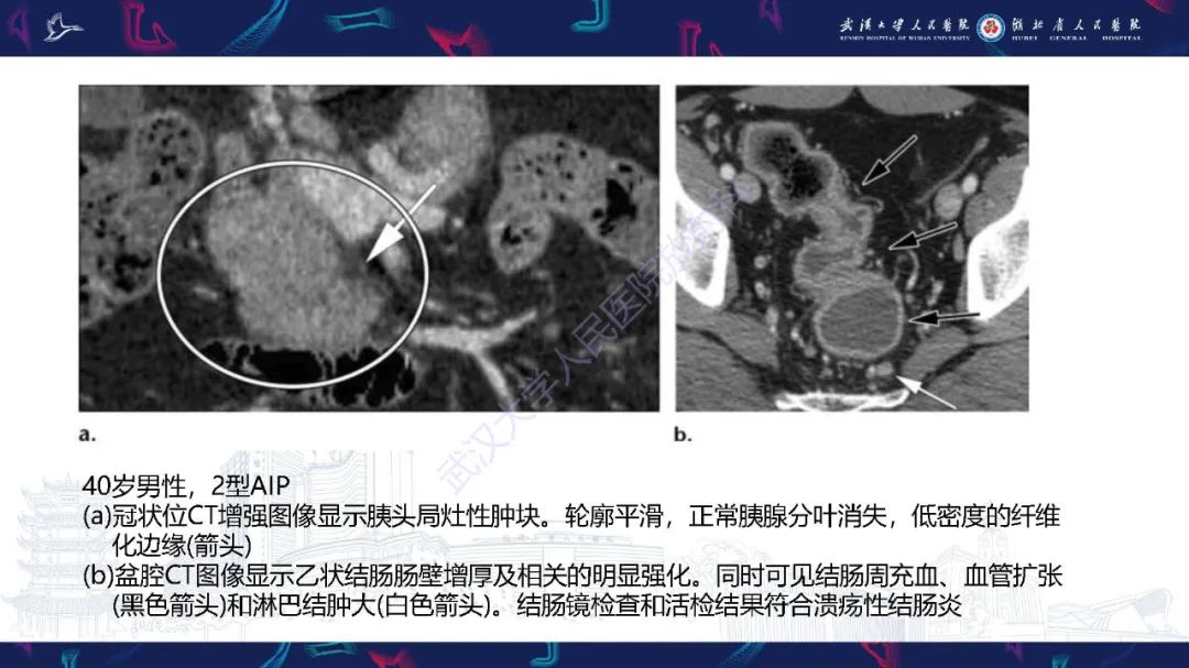 影像PPT - 【PPT】慢性胰腺炎与胰腺肿瘤影像鉴别诊断-33