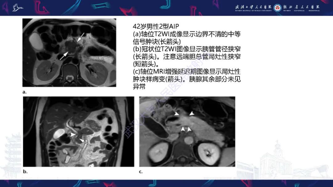 影像PPT - 【PPT】慢性胰腺炎与胰腺肿瘤影像鉴别诊断-34