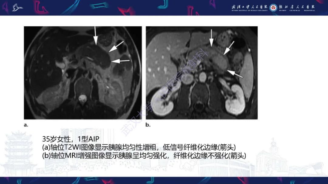 影像PPT - 【PPT】慢性胰腺炎与胰腺肿瘤影像鉴别诊断-35