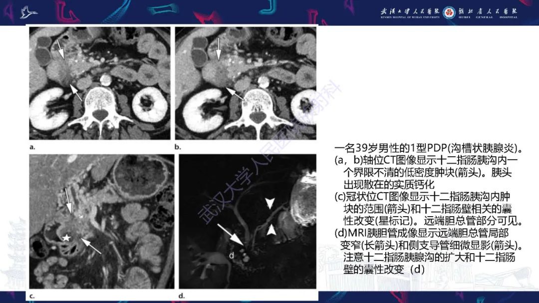 影像PPT - 【PPT】慢性胰腺炎与胰腺肿瘤影像鉴别诊断-39